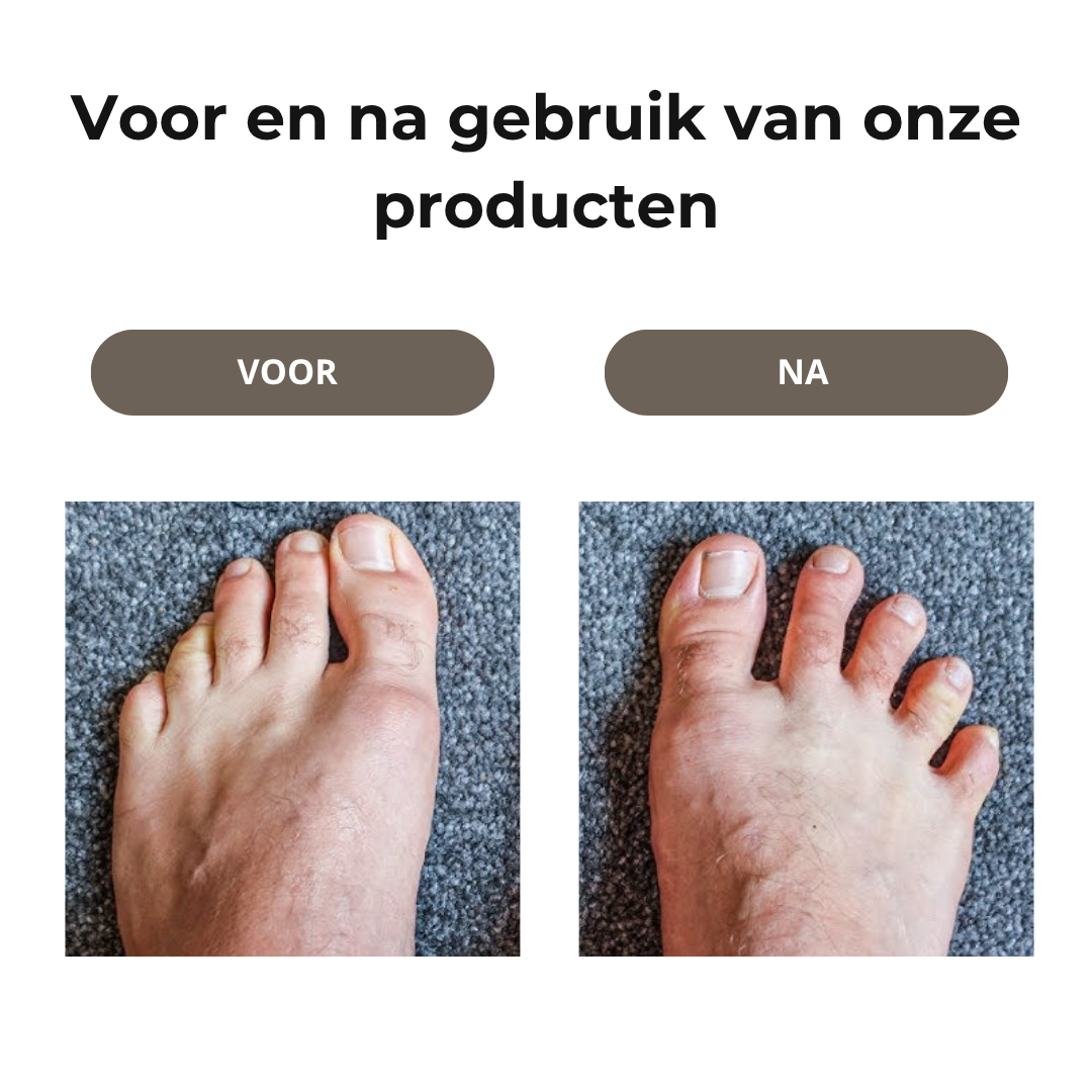 FlexiToe™ Uitlijningsset voor Gezonde Voeten